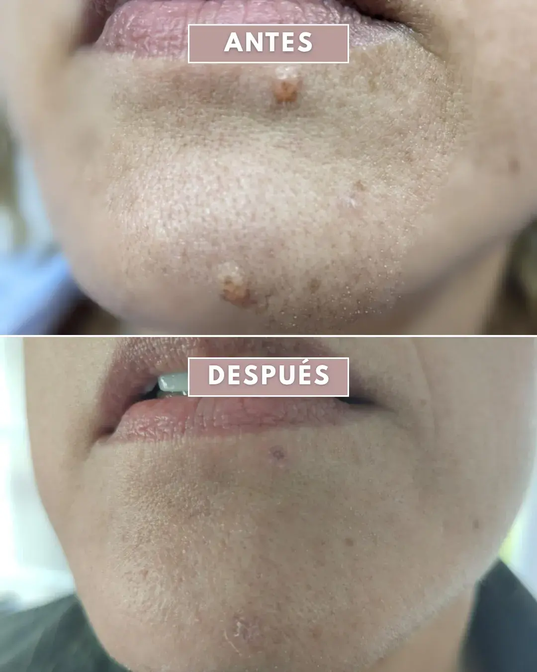 El antes y el después de un tratamiento con láser azul