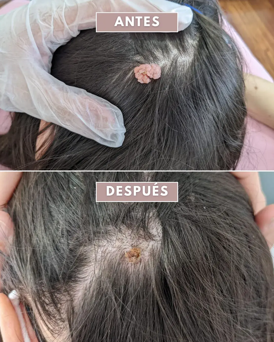 El proceso de un paciente con el láser azul